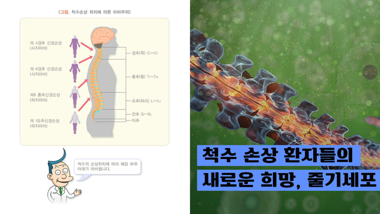 질병관리청- 척추손상 위치에 따른 마비부위