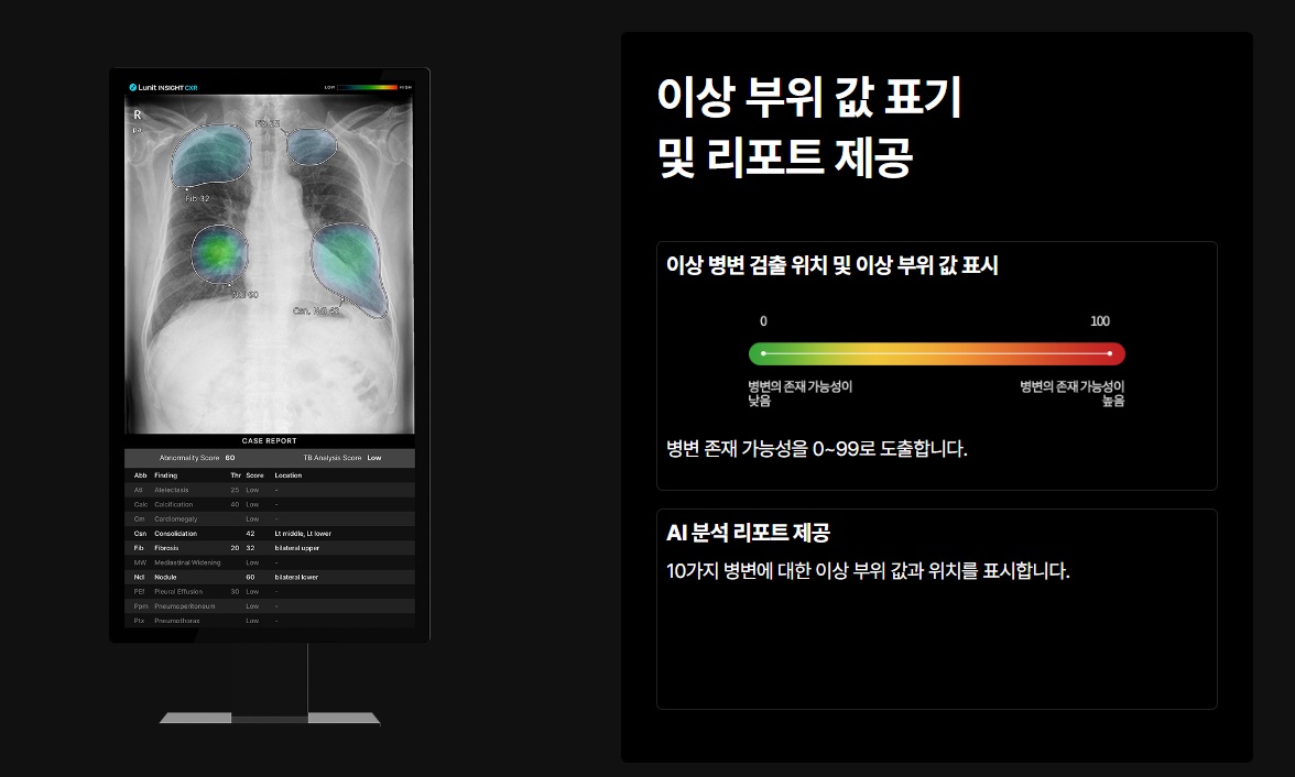 인공지능 기반 흉부 X-Ray 솔루션 '루닛 인사이트 CXR' / 출처 : 루닛 홈페이지