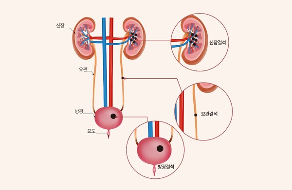 출처 : 분당서울대학교병원 홈페이지