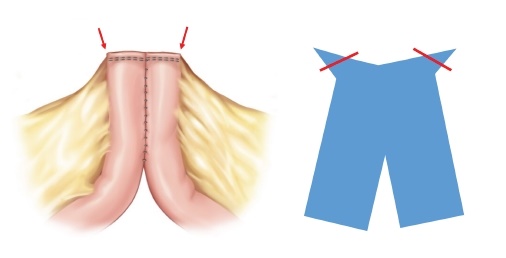 기존의 대장 스테이플링 문합술. 수술부위 양끝으로 볼록한 주머니가 생겨 염증 우려가 있었다 / 출처 : 서울아산병원 뉴스룸