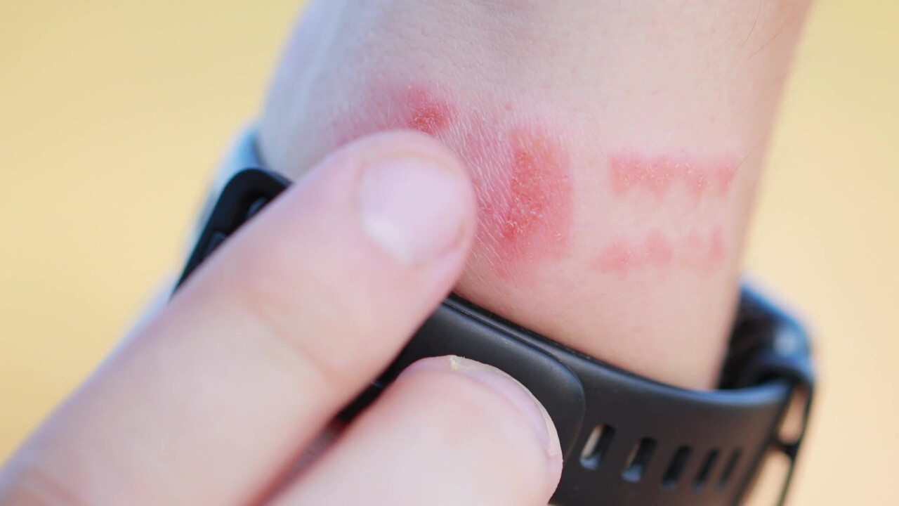 금속 등 특정 물질에 대해 알레르기 반응이 일어날 경우 '접촉성 피부염'일 가능성이 높다 / 이미지 출처 : 모션 엘리먼츠