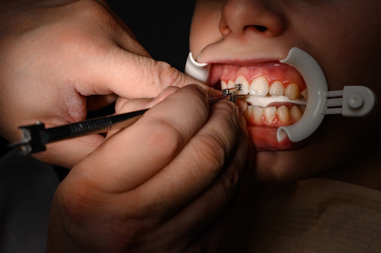 잇몸뼈 리모델링 속도는 성장기에 더 빠르기 때문에, 교정 치료는 보통 일찍 시작할 것을 권장한다 / 이미지 출처 : Motion Elements