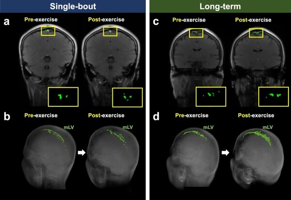 단발성 운동군과 지속적인 운동군의 대표 참가자들의 운동 후 mLV ROI 크기 변화 / 출처 : 네이처 커뮤니케이션즈