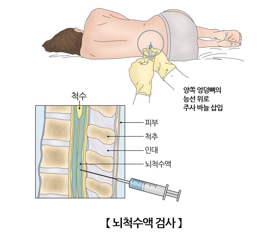 뇌척수액 검사는 비용은 저렴하지만 침습적 검사 방식으로 신체적, 시간적 부담이 큰 편이다 / 출처 : 서울아산병원