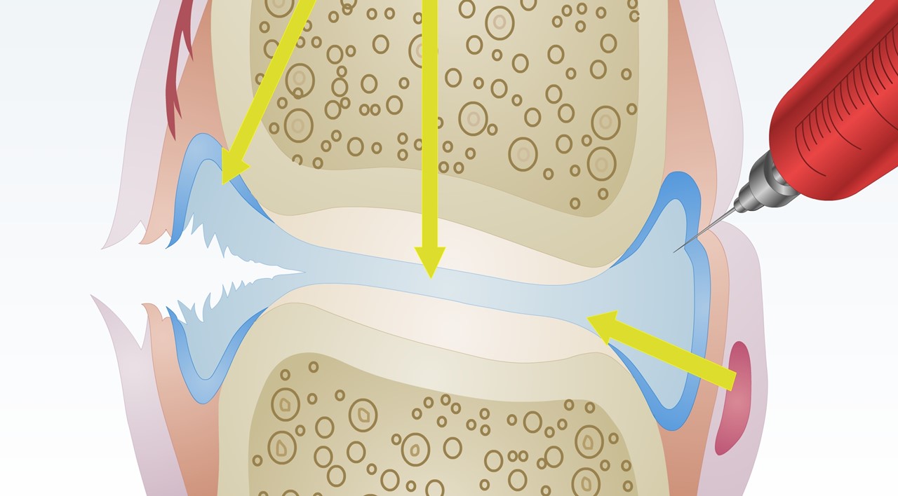 뼈와 뼈 사이에는 연골과 관절 활액이 존재한다 / 이미지 출처 : Motion Elements