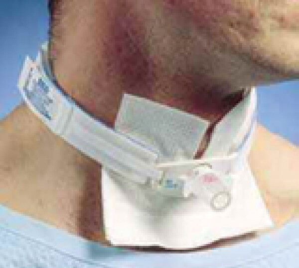 [사진] 기관절개관을 삽입한 모습