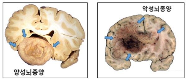 [자료3] 양성뇌종양과 악성뇌종양