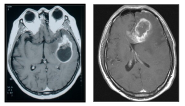 [자료4] 악성 뇌종양(교모세포종) MRI