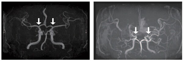 [사진 왼쪽부터] 정상 및 모야모야병 환자의 뇌혈관